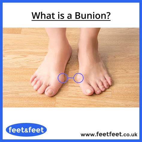 A bunion is a foot deformity which can develop when the toes are too constrained – usually as a ...