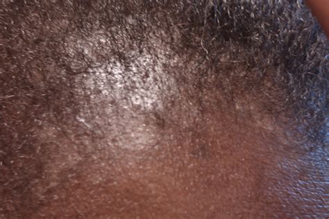 seborrheic dermatitis hairline - pictures, photos