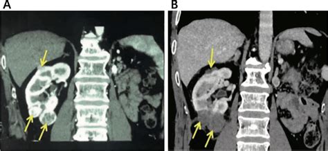 Before and after cryoablation in patients with renal cancer. A ...