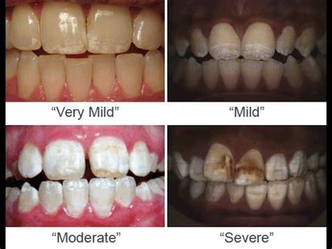 Shocking #FluorideDangers to Avoid! >> Learn more at http://wiselygreen.com/shocking-flouride ...