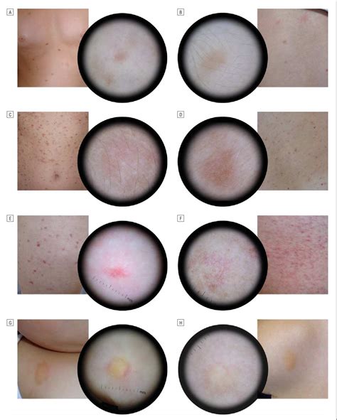 Figure 1 from Dermoscopic features of skin lesions in patients with ...