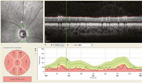 OCT, RNFL thickness, Right Eye, Patient A. | Download Scientific Diagram