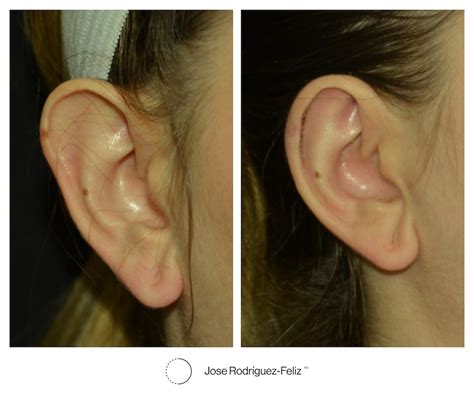 If You Have Ever Wanted Smaller Ears, Macrotia Ear Surgery Is For You