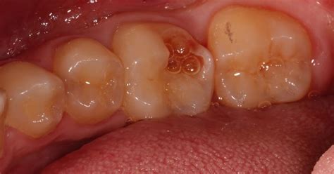 Tooth Nerve Exposed