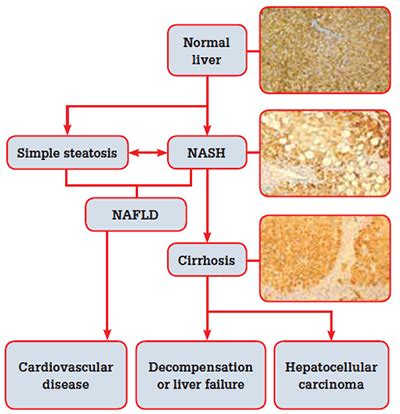 Top 9 fatty liver ast alt level chart 2022