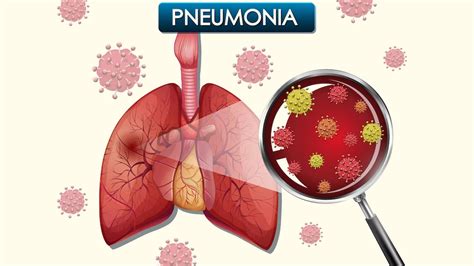 World Pneumonia Day 2023: Know Its Causes, Risk, Symptoms And Prevention | OnlyMyHealth