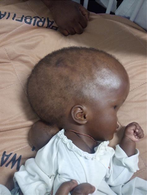 Child with macrocephaly and occipital encephalocele | Download ...