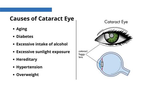 EVERYTHING YOU NEED TO KNOW ABOUT CATARACT! - OPHTHALMOLOGY