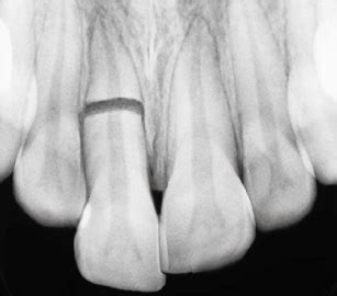 Root Fracture | Pocket Dentistry