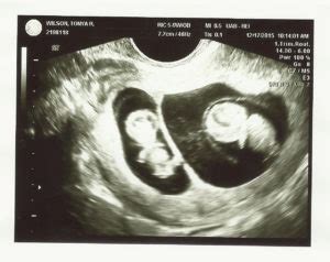 9 weeks ultrasound(1) - Twiniversity