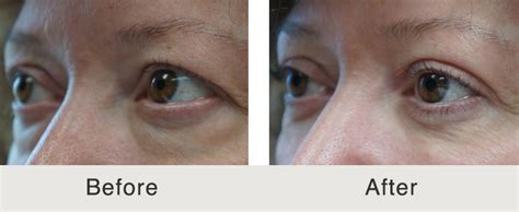 Eye Bag Surgery Before and After | Carolina Facial Plastics