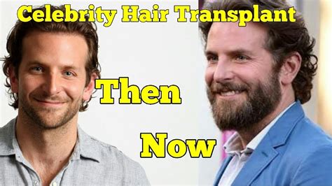 20 Celebrity Hair Transplants Before and After - YouTube