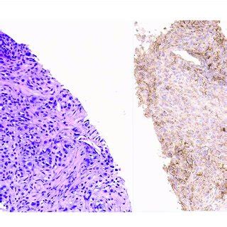 | Pathology image of lung nodule biopsy showing PD-L-1 positivity. On... | Download Scientific ...