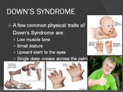 HSC 425 Congenital Chromosomal Birth Defects - YouTube