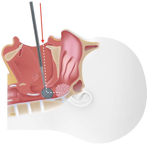 Tonsillectomy and Adenoidectomy - Fort Worth ENT & Sinus