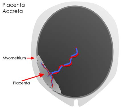 Placenta Accreta - Causes, Symptoms, Diagnosis, Risk Factors, Treatment