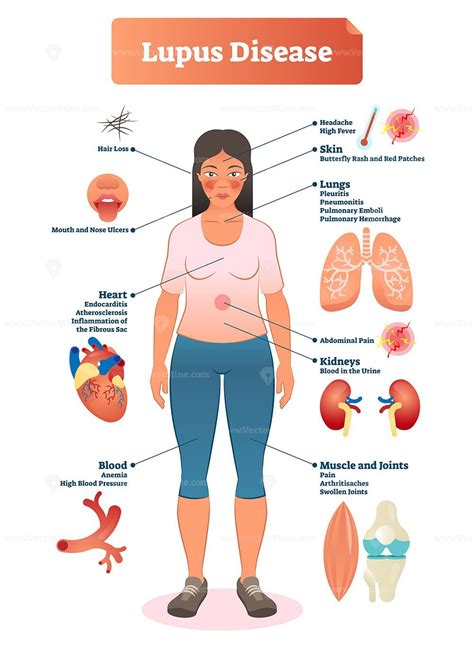 Lupus disease vector illustration - VectorMine