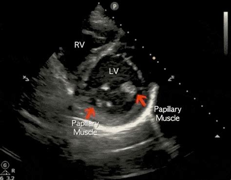 Cardiac Ultrasound (Echocardiography) Made Easy: Step-By-Step Guide ...