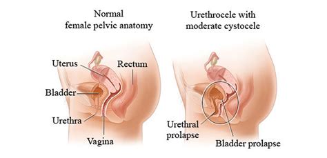 Urethral Injuries: Causes, Symptoms, & Treatment Options