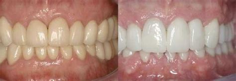 Amazing Facts About Zirconia Crowns Vs. Porcelain Fused To Metal Crowns ...