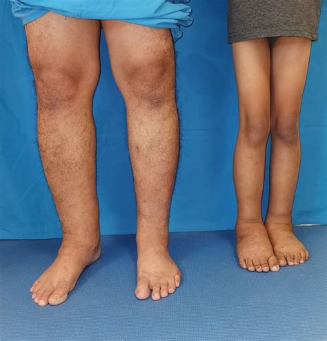 Primary Lymphedema in a Pediatric Patient | Consultant360