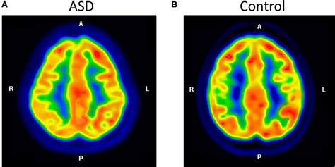 Frontiers | Brain laterality evaluated by F-18 fluorodeoxyglucose ...