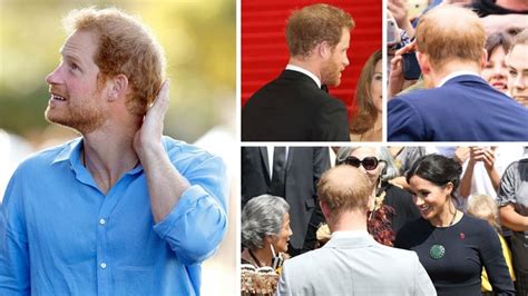 Prince Harry's Bald Spot Has Doubled in Size in Just One Year | Blush