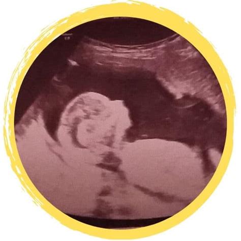 Trisomy 13 Ultrasounds and a Plan - Terminations Remembered