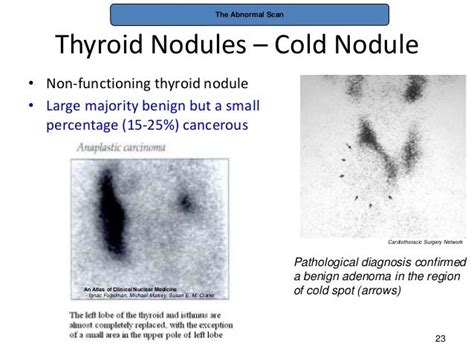 Thyroid pathophysiology scintigraphy[1]