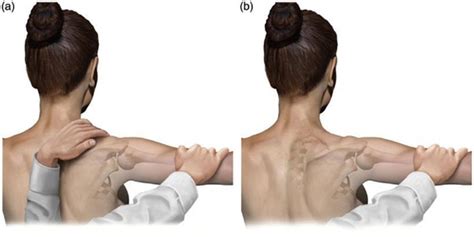 Scapular Dyskinesis | Scapular Disorders | Bangalore Shoulder Institute