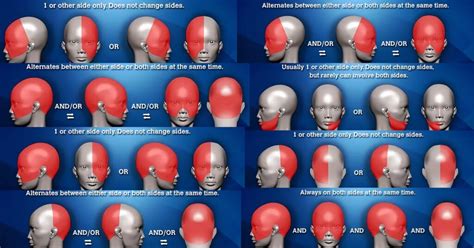 Location of Headache Meaning and Headache Placement Meanings on Headache Charts - Virtual ...