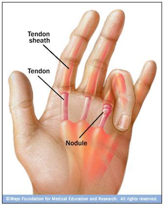 Repetitive Stress Injury Treatment: Trigger Finger Splint from BraceAbility.com