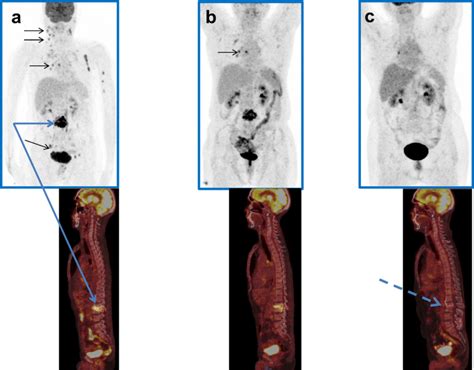 Serial scans in a patient with EPTB involvement of bone (L1–L2 ...