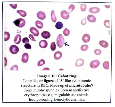 Cabot Ring RBC - Megaloblastic anaemia ... | Hematology, Medical ...