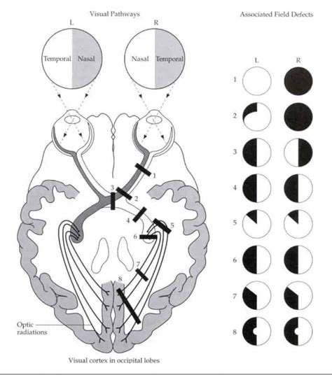 Heteronymous Hemianopia: A Visual Field Condition Resulting, 51% OFF