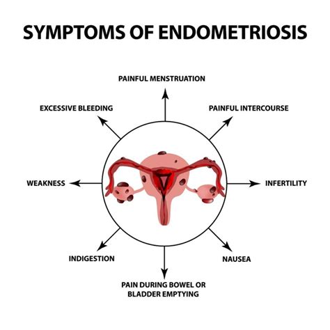 Get relief from Endometriosis with Physical Therapy - Relief Physical ...