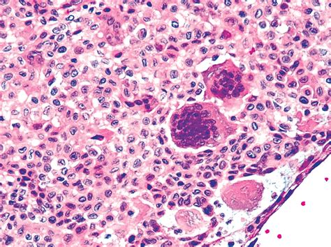 Pathology Outlines - Chondroblastoma