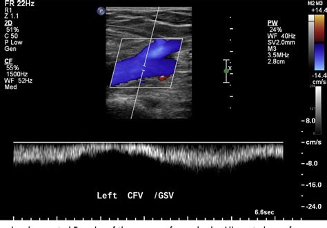 Figure 14 from Update on the lower extremity venous ultrasonography examination. | Semantic Scholar