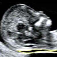 What is Nuchal Translucency? - City Ultrasound