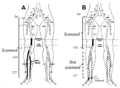 Arterial Duplex Lower Extremity