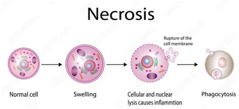 Cell Death by Necrosis Flashcards | Quizlet