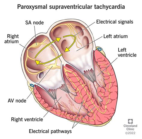 Paroxysmal Supraventricular Tachycardia (PSVT): Causes & Symptoms