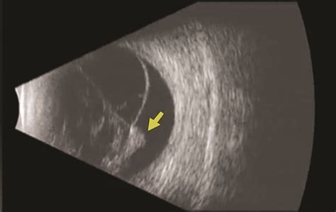 Figure 2. B-scan ultrasound of a patient with PVR-related retinal ...