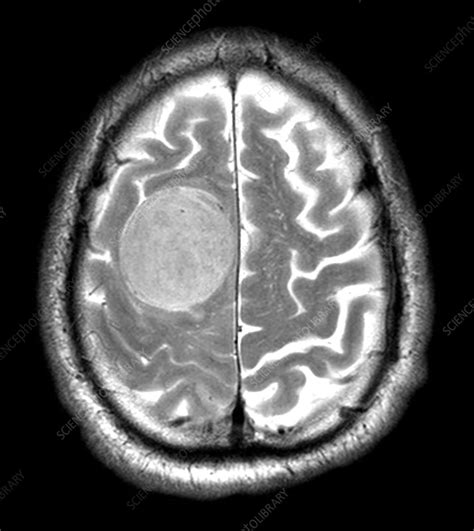 Large Meningioma on MRI - Stock Image - C027/1685 - Science Photo Library