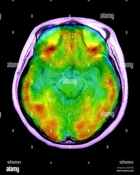 Flujo sanguíneo cerebral normal. Color compuesto por resonancia ...