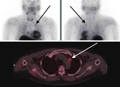 Sestamibi parathyroid scan showing uptake in a mediastinal ectopic... | Download Scientific Diagram