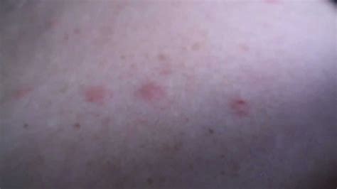 Shingles Rash Early Stages - YouTube