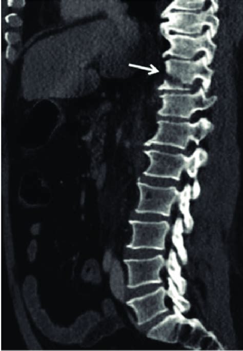 Vertebral injury. A vertical fracture line is observed in the T10 ...