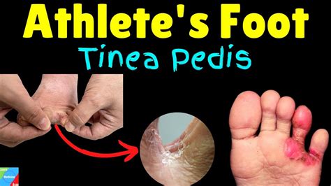 Athlete's Foot (Tinea pedis): Symptoms, Causes & Treatment - Foot ...