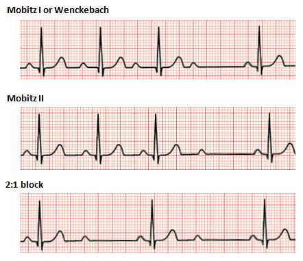 File:Second degree heart block.png - Wikimedia Commons